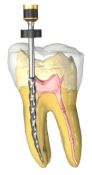 Endodontinis dantų gydymas